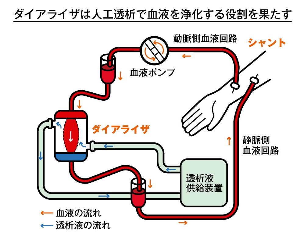 ダイアライザ　人工透析　血液　浄化　ニプロ　日本式医療　輸出